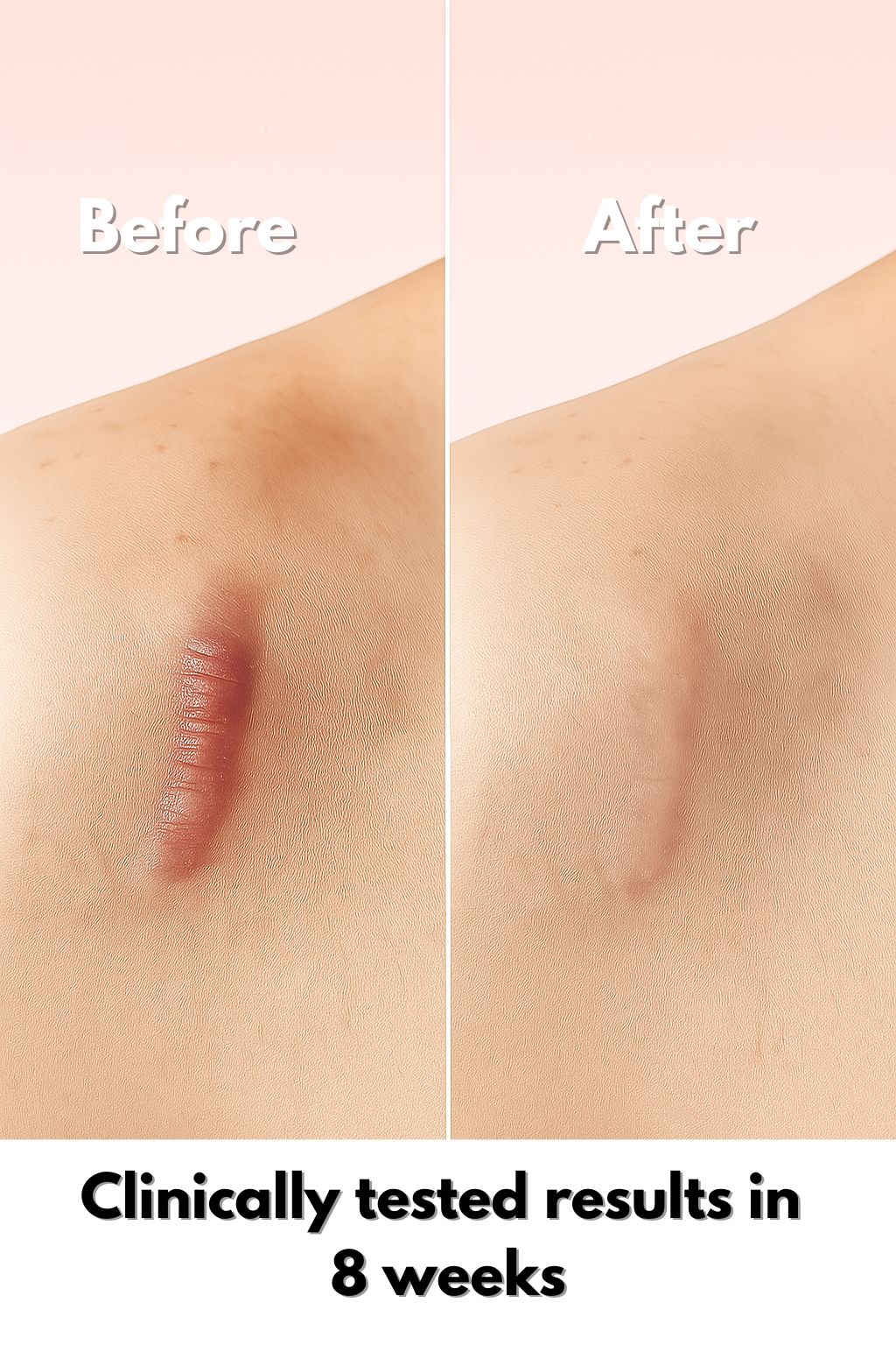 MomGlo™ Collagen Scar Recovery
