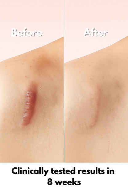MomGlo™ Collagen Scar Recovery