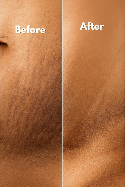 MomGlo™ Collagen Scar Recovery