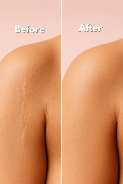 MomGlo™ Collagen Scar Recovery